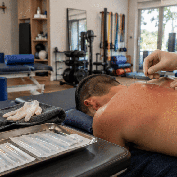 Physiotherapist performing dry needling therapy on a patient's upper back in a modern physiotherapy clinic with rehabilitation equipment and natural daylight.